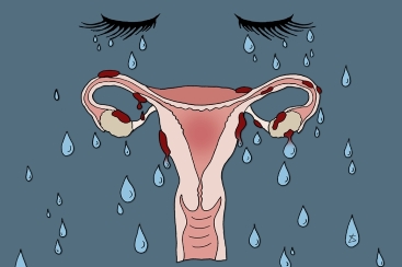 Endometriózis